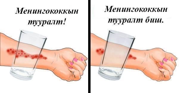 Баянзүрх дүүрэгт менингококк халдвар бүртгэгдэж, зөвлөмж гаргалаа